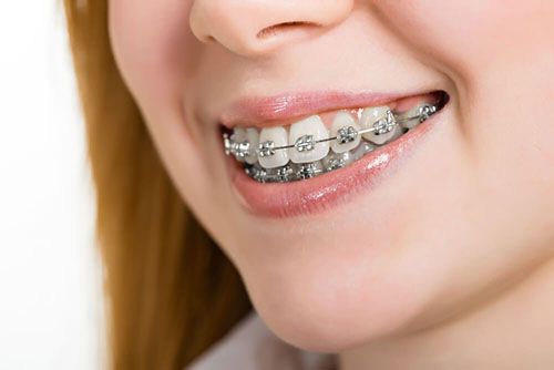 Braces Dentist Wantirna South