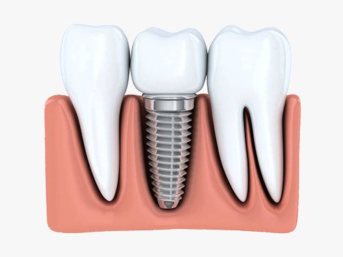 Dental Implants Dentist Wantirna South