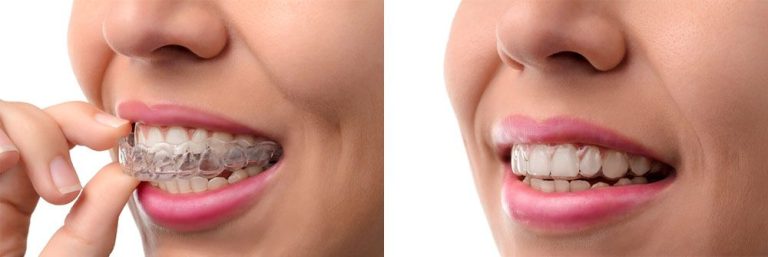  Invisalign - Wantirna South - Elite Smiles