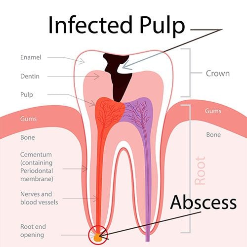 Root Canal Treatment Wantirna South