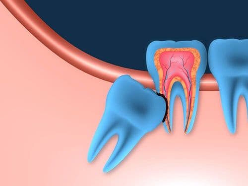 Wisdom Tooth Removal Wantirna South