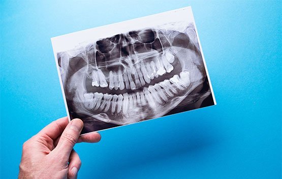 Bone Grafting Wantirna South