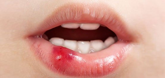 soft tissues injuries in the mouth wantirna south